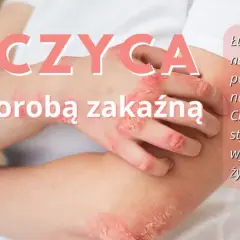 Łuszczyca na łokciach i dłoniach. Choroba nie jest zakaźna, ale wpływa na jakość życia i może prowadzić do napięcia psychicznego.