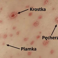 Początek ospy: widoczne plamki, krostki i pęcherzyki na skórze.