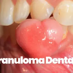 Un granuloma gengivale, una piccola protuberanza rosa, cresce tra i denti.