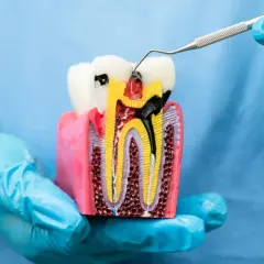 Model zęba pokazuje, ile kanałów ma 4 górna. Widać próchnicę i narzędzie dentystyczne.