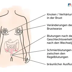 Illustration zeigt, wie ein Tumor aussehen kann: Knoten in der Brust, Veränderungen der Brustwarze, Blutungen, Schmierblutungen und bräunlicher Ausfluss.