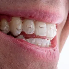 Uśmiech z przezroczystymi nakładkami Invisalign. Zastanawiasz się nad Invisalign cena? To dyskretne rozwiązanie dla prostych zębów.