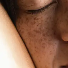 Primo piano del viso di una persona con lentiggini, con l'occhio chiuso e la guancia appoggiata su un tessuto. Si notano sottili rughe da cuscino.