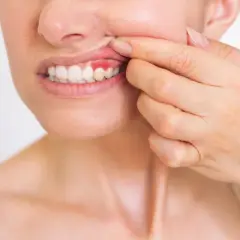 Donna mostra una gengiva gonfia e rossa, possibile conseguenza di una devitalizzazione dentale.