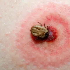 Cómo se llama la enfermedad de las garrapatas y sus riesgos ocultos