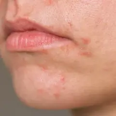 Haut um den Mund mit Rötungen und Pickelchen. Periorale dermatitis nulltherapie hilft nicht, die Haut ist gereizt.