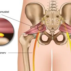 Piriformis-Muskel drückt auf Ischiasnerv, Ursache für Ischias Schmerz. Detailansicht zeigt Nerveneinklemmung.