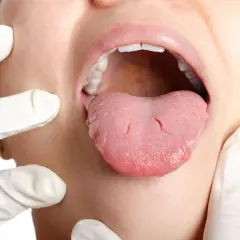 Arzt untersucht Zunge auf mögliche zungenkrebs symptome. Die Zunge ist herausgestreckt, die Lippen geöffnet.
