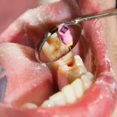 Widok jamy ustnej z widocznym narzędziem dentystycznym i zębem. Widać stan zapalny dziąsła, a w odbiciu lusterka fragment zęba z widoczną ropą.
