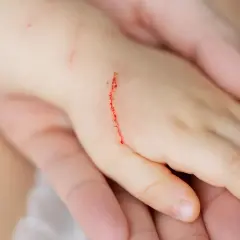 Dziecko ma zadrapanie na ręce, które może być objawem choroby kociego pazura.