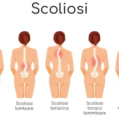 Illustrazione dei diversi tipi di scoliosi e dei relativi sintomi: colonna sana, scoliosi lombare, toracica, toraco-lombare e combinata.