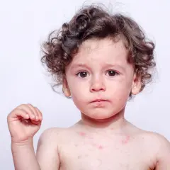 Szkarlatyna kiedy do przedszkola? Sprawdź, kiedy dziecko może wrócić