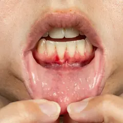 Gengive arrossate e infiammate, con un punto sanguinante, che mostrano perchè si ritirano le gengive. Dettaglio della bocca.