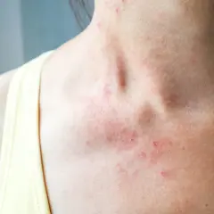 Alergia skórna: objawy, przyczyny i skuteczne sposoby leczenia