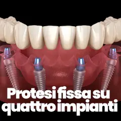 Protesi fissa su quattro impianti dentali, mostrando la struttura ossea e i pilastri che sostengono i denti.