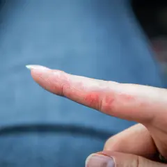 Czerwona, sucha skóra na palcu, objawy uczulenia na nikiel.