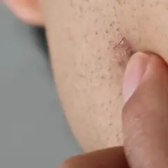 Dedo tocando un pequeño bulto rojo en la piel, con un pelo encarnado visible.