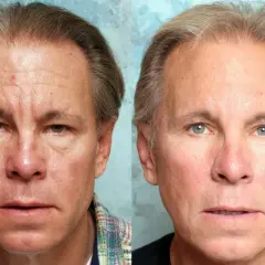 Före- och efterbilder av en man som visar minskade rynkor och en slätare hud efter ansiktsyoga.