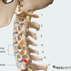 Anatomie du rachis cervical, montrant les localisations des hernies discales. Le temps de guérison d'une hernie cervicale dépend de sa gravité.
