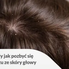 Widoczne białe płatki na ciemnych włosach wskazują na problem z łupieżem. Dowiedz się, jak pozbyć się łupieżu ze skóry głowy.