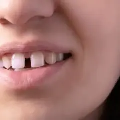 Diastema: Czy szpara między jedynkami to problem? Jak ją leczyć?
