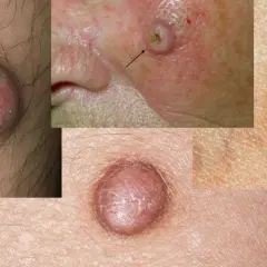 Hautveränderungen: Beulen, rote Flecken und dunkle Muttermale zeigen, wie schaut hautkrebs aus.