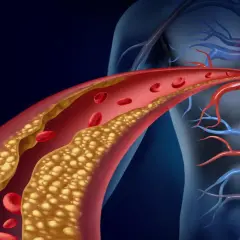 Zaburzenia lipidowe (dyslipidemia) to stan, gdy we krwi jest za dużo złego cholesterolu, co prowadzi do zwężenia naczyń krwionośnych i problemów z sercem.