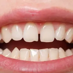 Szczelina między zębami, czyli diastema, jest widoczna na zbliżeniu uśmiechu.