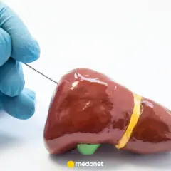 Rękawiczka w niebieskiej rękawiczce delikatnie wprowadza biopsja gruboigłowa igła do modelu wątroby.
