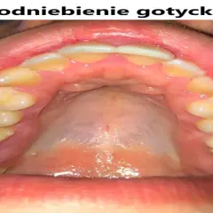 Widok jamy ustnej z zębami i podniebieniem. Podniebienie gotyckie, zdrowe, z widocznymi zębami.