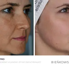 Przed i po fototerapii VPL PRO: widoczna redukcja przebarwień hormonalnych i plam posłonecznych na skórze twarzy.