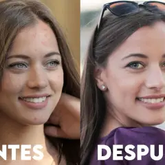 Antes y después de un tratamiento para el acné. La piel de la mujer luce más limpia y radiante, mostrando los beneficios de deripil.
