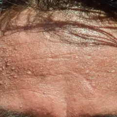 Frente sudorosa, con gotas de agua brillando. ¿Buscas trucos para no sudar por la cabeza?
