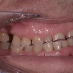 Denti con segni visibili di erosione dentale, con smalto consumato e bordi irregolari.