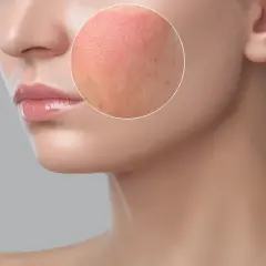 Gros plan sur une joue avec une tache rouge, montrant la texture de la peau et quelques imperfections.