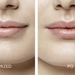 Ile kosztuje 1 ml kwasu hialuronowego w usta? Sprawdź ceny w klinikach