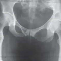 Czym jest ognisko osteolityczne? Przyczyny, objawy i diagnostyka zmian w kościach