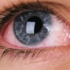 Occhio congiuntivite: arrossamento e secrezioni indicano possibili cause virali o batteriche.