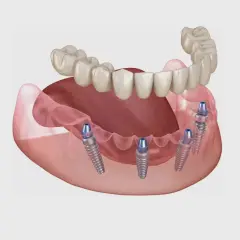 Immagine di protesi dentali fisse su impianti, una soluzione innovativa per chi cerca impianti dentali senza bucare osso.