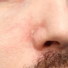 Piel enrojecida y escamosa alrededor de la nariz y la barba, indicativo de dermatitis seborreica barba.
