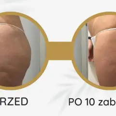 Endermologia: Gładka skóra bez cellulitu? Poznaj efekty i fakty