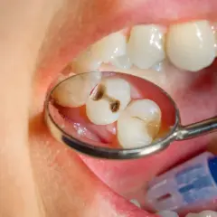 Specchio dentale riflette due denti con evidenti carie. Un dente ha una cavità scura, l'altro mostra un'area danneggiata.