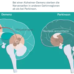 Gehirnschnitt zeigt Unterschiede bei Demenz und Parkinson. Bei Alzheimer-Demenz sterben Nervenzellen im Grosshirn und Hippocampus ab.