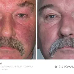 Przed i po leczeniu trądziku różowatego u mężczyzny. Skóra twarzy wyraźnie mniej zaczerwieniona, rumień zredukowany.