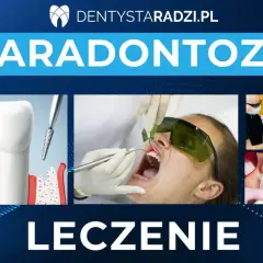 Leczenie paradontozy: ilustracja zęba z ubytkami kostnymi, zabieg laserowy i stomatologiczne procedury.