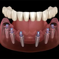 Modello 3D di un impianto dentale fisso con sei viti inserite nell'osso mascellare, pronte a sostenere una protesi dentale.