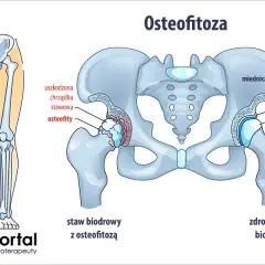 Osteofitoza: Jaka rehabilitacja? Odzyskaj sprawność i zwalcz ból!