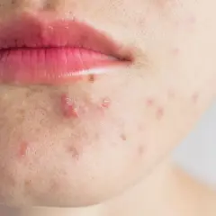 Nahaufnahme von Lippen und Kinn mit fettiger Haut und Pickeln.