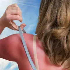 Skuteczne leki na oparzenia słoneczne, które przyniosą ulgę i szybkie wyleczenie