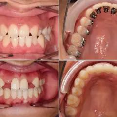 Denti con agenesia dentale, alcuni con apparecchio ortodontico, in diverse viste.